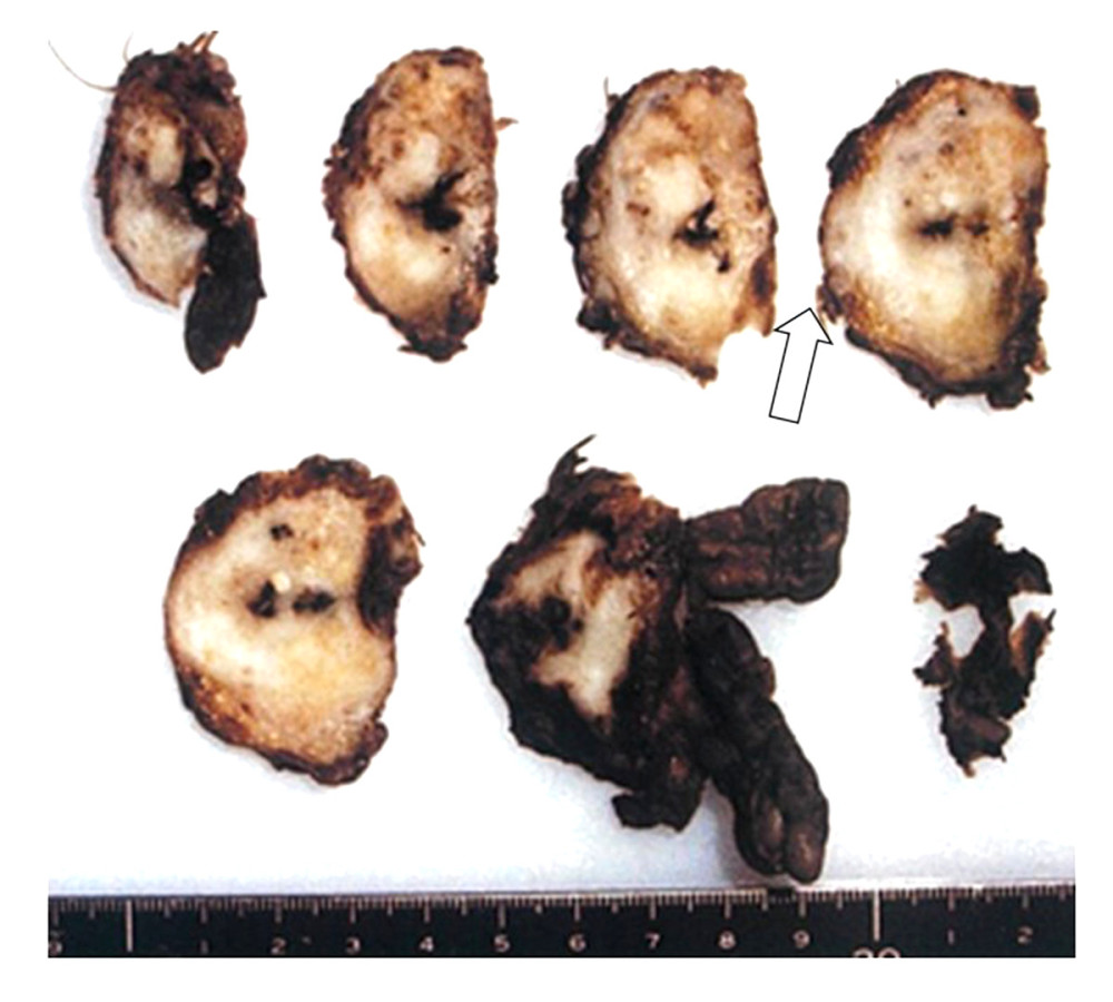A 25-mm ill-defined mass lesion with capsular infiltration was observed in the right lobe of the prostate (white arrow).