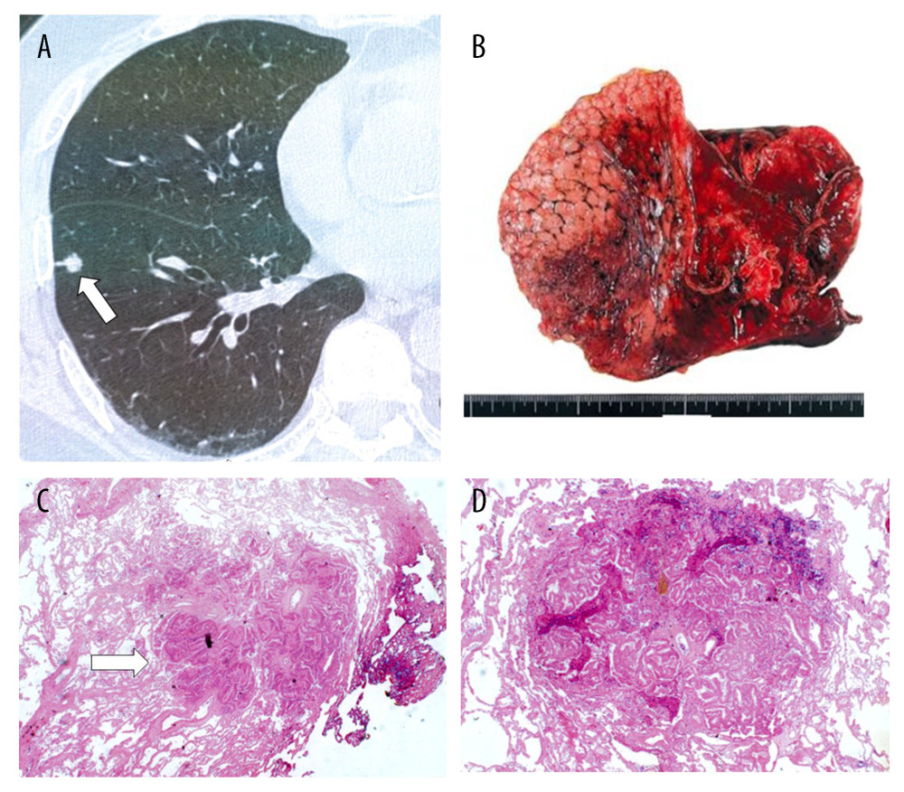 (A) Three small 10-mm nodular lesions were identified on follow-up computed tomography (white arrow), and (B) the resected specimen of the right lower lobe of the lung. Histological findings indicated metastatic lung adenocarcinoma from prostate cancer; (C) ×40 magnification (white arrow) and (D) ×100 magnification.