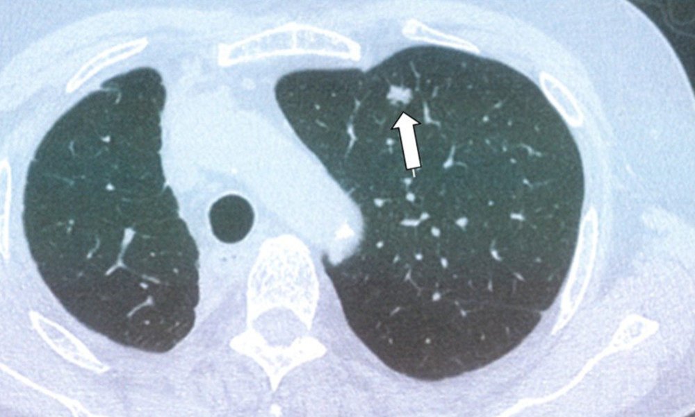 Subsequent metastases were identified in the left upper lobe of the lung, which were aggressively resected by video-assisted thoracic surgery segmentectomy (white arrow).