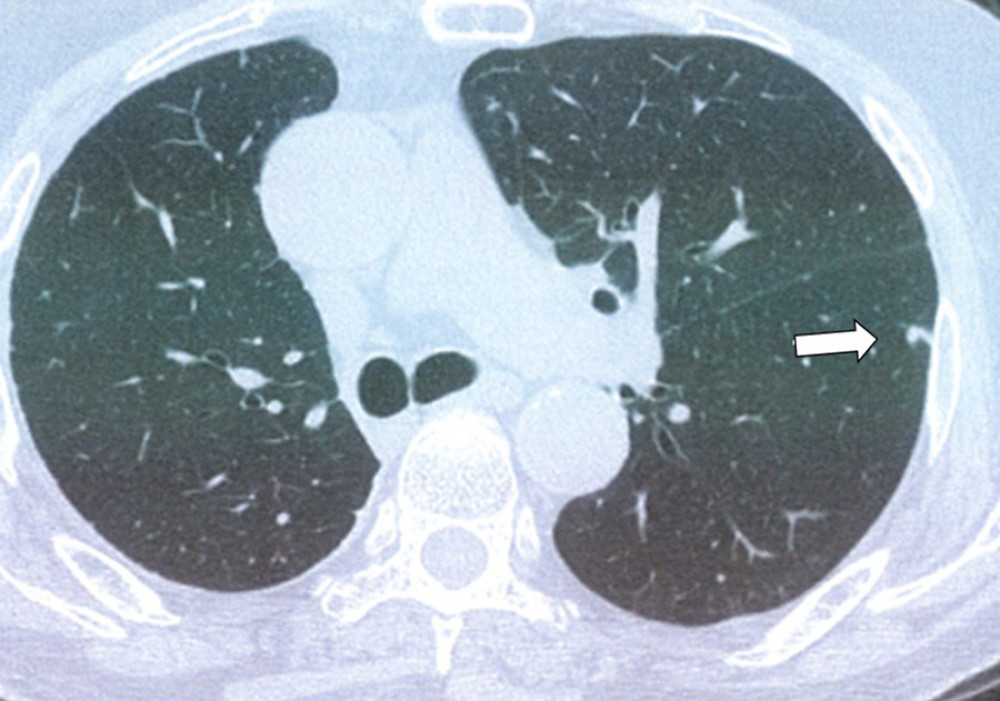 The third metastatic lung cancer, which was partially resected (white arrow).