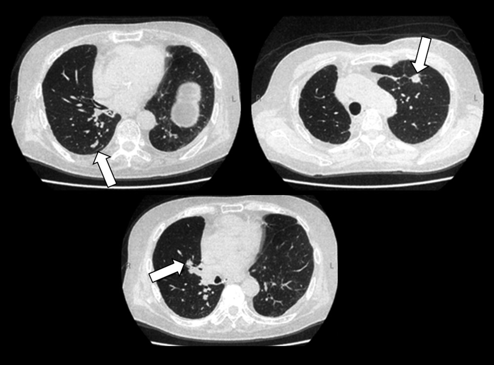 The final recurring multiple metastatic lung cancers in both lungs without any treatment interventions (white arrow).