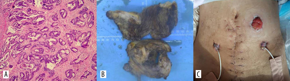 (A) Histological examination revealed a moderate differentiated adenocarcinoma. (B) The tumor was resected en block. (C) Sigmoid colostomy and bilateral ureterostomy were performed.