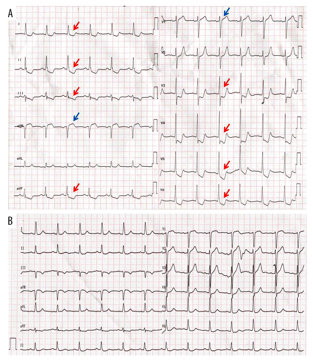 Twelve-lead electrocardiogram (ECG) findings at admission and after treatment. (A) The ECG at admission revealed extensive ST-segment depression in leads I, aVL, II, III, aVF, and V3–V6 (see red arrows) and ST-segment elevation in leads aVR and V1 (see blue arrows). (B) The ECG after treatment revealed that ST segments in all leads almost returned to normal.