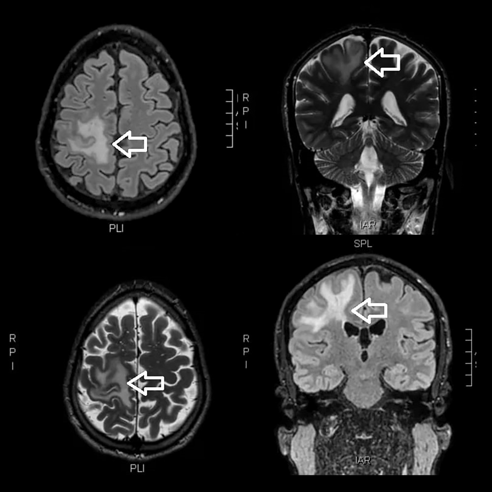 MRI after the relapse of CM. Arrows indicated a focal lesion in right frontal-parietal with increased intensity in T2 and FLAIR images.