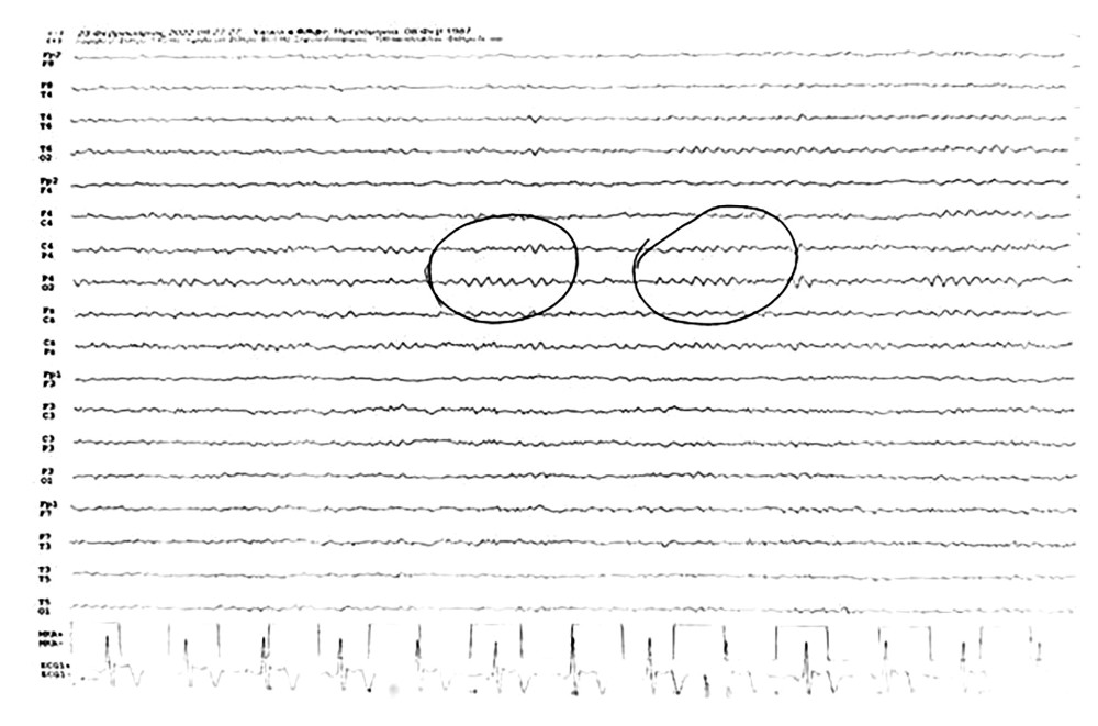 Electroencephalography. Slow activities of theta and delta waves were recorded mainly in the right hemisphere and occipital electrodes (indicated by circle).