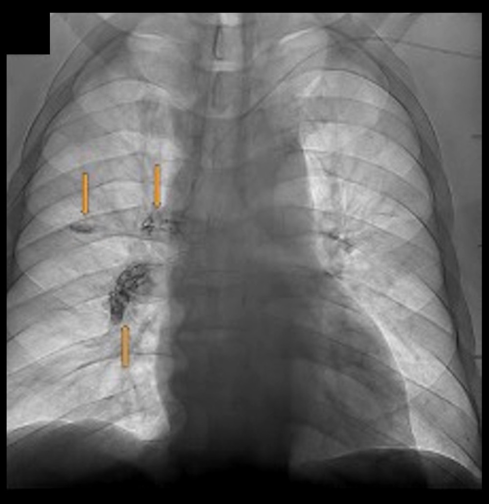 Fluoroscopic Imaging During Peripherally Inserted Central Catheter (PICC) Placement Showing Pulmonary Embolism. Fluoroscopic image highlighting linear densities (arrows) within the pulmonary artery distribution during peripherally inserted central catheter (PICC) placement 4 weeks after percutaneous vertebroplasty