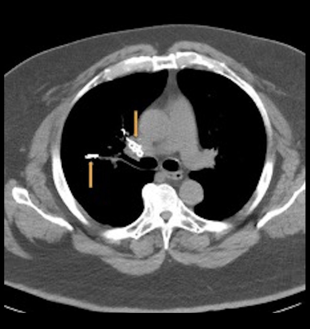 Computed Tomography (CT) of the Chest Confirming Pulmonary Embolism. Axial image taken from computed tomography (CT) of the chest confirming the presence of radiopaque material within the right main pulmonary artery (arrows) with extension into the right upper, middle, and lower lobar arteries (arrows).