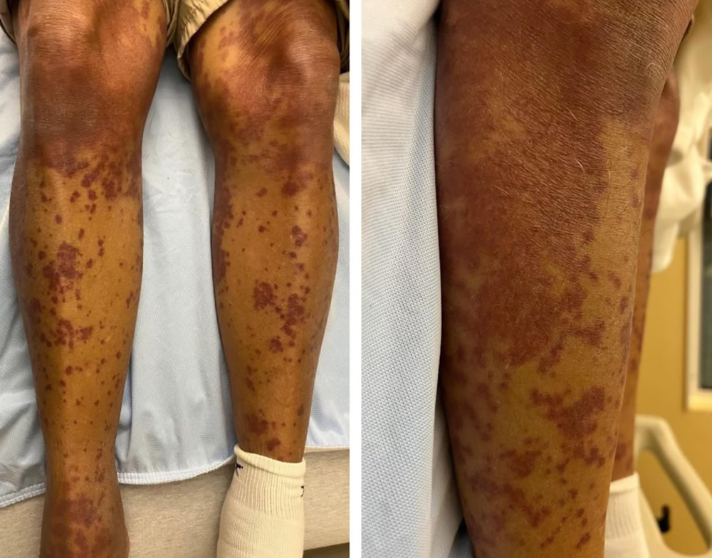 Photograph of the diffuse, non-blanchable purpuric macules and patches on the lower extremities of an 89-year-old man secondary to linezolid-induced purpuric drug eruption.