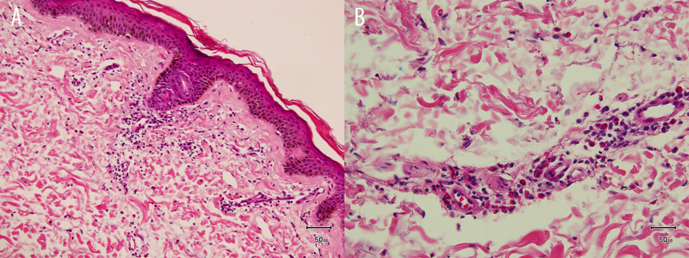 Photomicrographs of a skin punch biopsy from the purpuric rash of the abdominal wall in an 89-year-old man with linezolid-induced purpuric drug eruption. (A) The skin biopsy shows a superficial and perivascular interstitial infiltrate of lymphocyte and eosinophil polymorphs infiltrating dermal capillaries and venules. Hematoxylin and eosin (H&E); magnification 100×. (B) Closeup of the skin biopsy shows predominance of eosinophils in the perivascular infiltrate. H&E; magnification 400×.