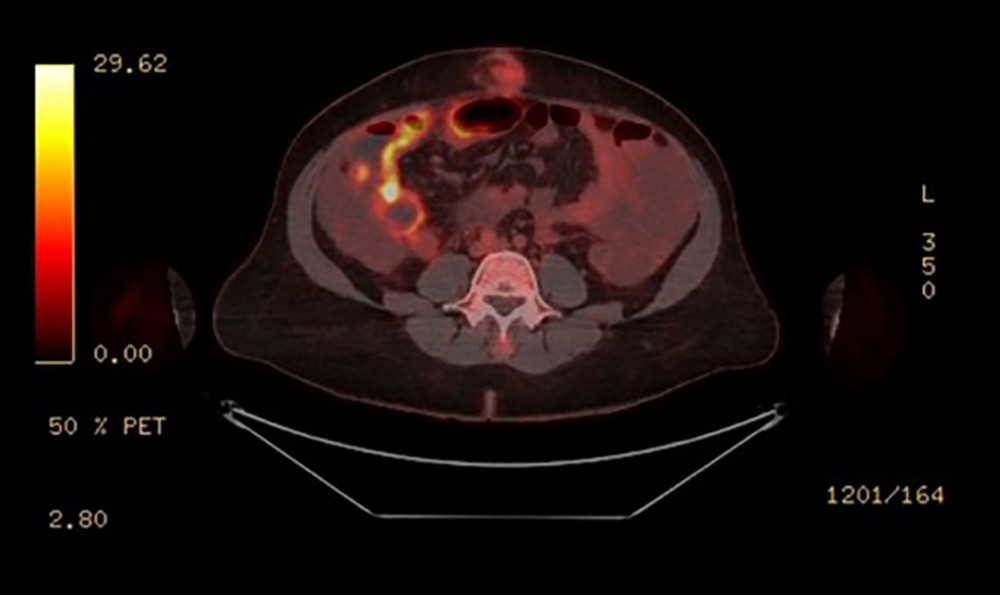 Axial positron emission tomography-computed tomography (PETCT) showing diffuse peritoneal thickening with multiple areas of F-fluorodeoxyglucose (FDG) activity consistent with the diagnosis of peritoneal mesothelioma.