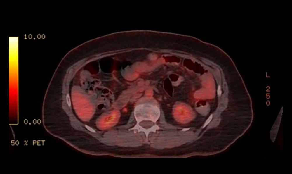 Axial positron emission tomography-computed tomography (PETCT) showing complete resolution of the previously noted mild F-fluorodeoxyglucose (FDG) avid peritoneal mesothelioma as well as ascites.