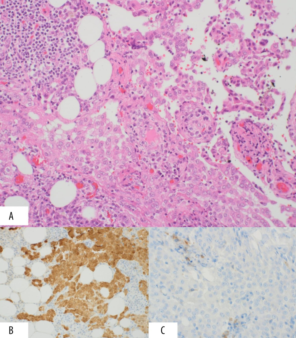 (A) Section shows an infiltrative epithelioid neoplasm with cytologic atypia, numerous cell mitoses, and focal papillary architecture. The tumor is infiltrating the mesenteric fat with associated chronic inflammation. Tumor cells have moderate eosinophilic cytoplasm, vesicular nuclear chromatin, and visible nucleoli. (Hematoxylin and eosin stain; magnification 20×). (B) Tumor cells show diffuse positivity (nuclear and cytoplasmic staining) for calretinin (immunohistochemical stain; magnification 20×). (C) Tumor cells are negative for BER-EP4 (immunohistochemical stain; magnification 40×).