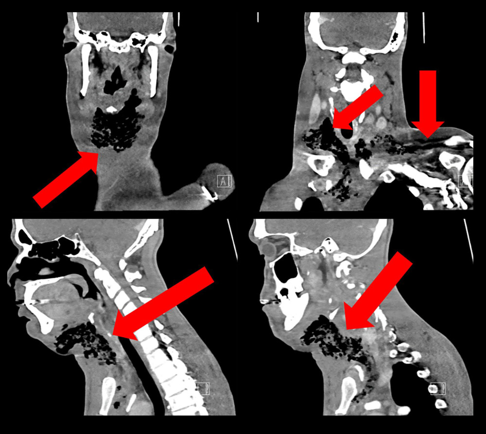 Computed tomography of the head and neck. There is extensive subcutaneous emphysema (red arrows) extending through the bilateral submental regions and along the fascial planes of the anterior neck to the level of the superior mediastinum, frontal, and sagittal views.