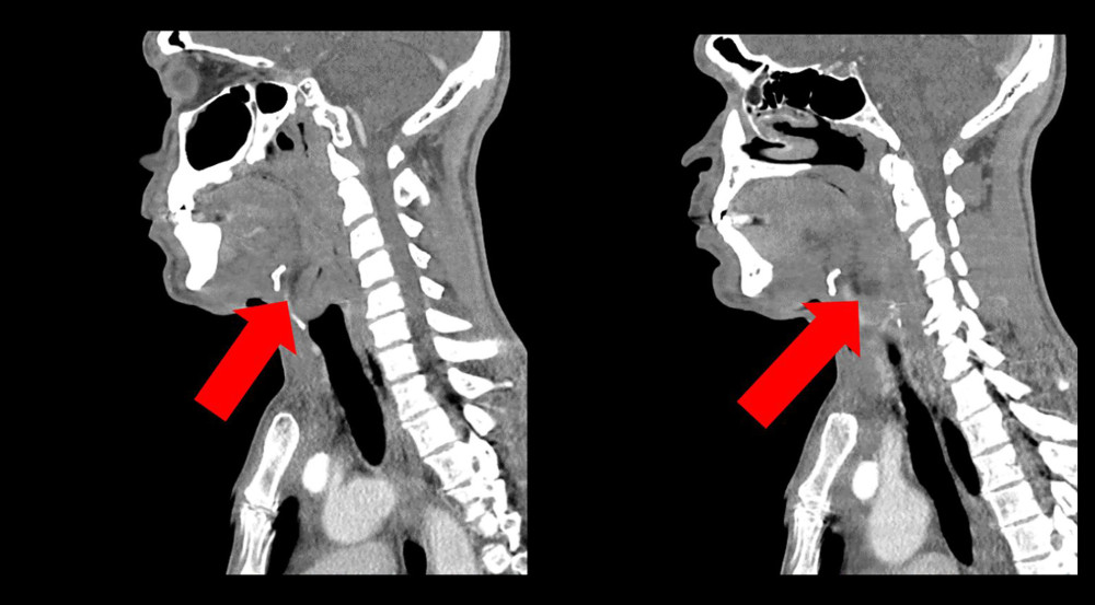 Follow-up computed tomography of the neck. There is diffuse soft tissue edema and inflammatory changes with an apparent open wound in the left anterior neck with some adjacent soft tissue gas pockets (red arrows) tracking to the left supraclavicular region that may be postsurgical and airway effacement, particularly in the region of the oropharynx.