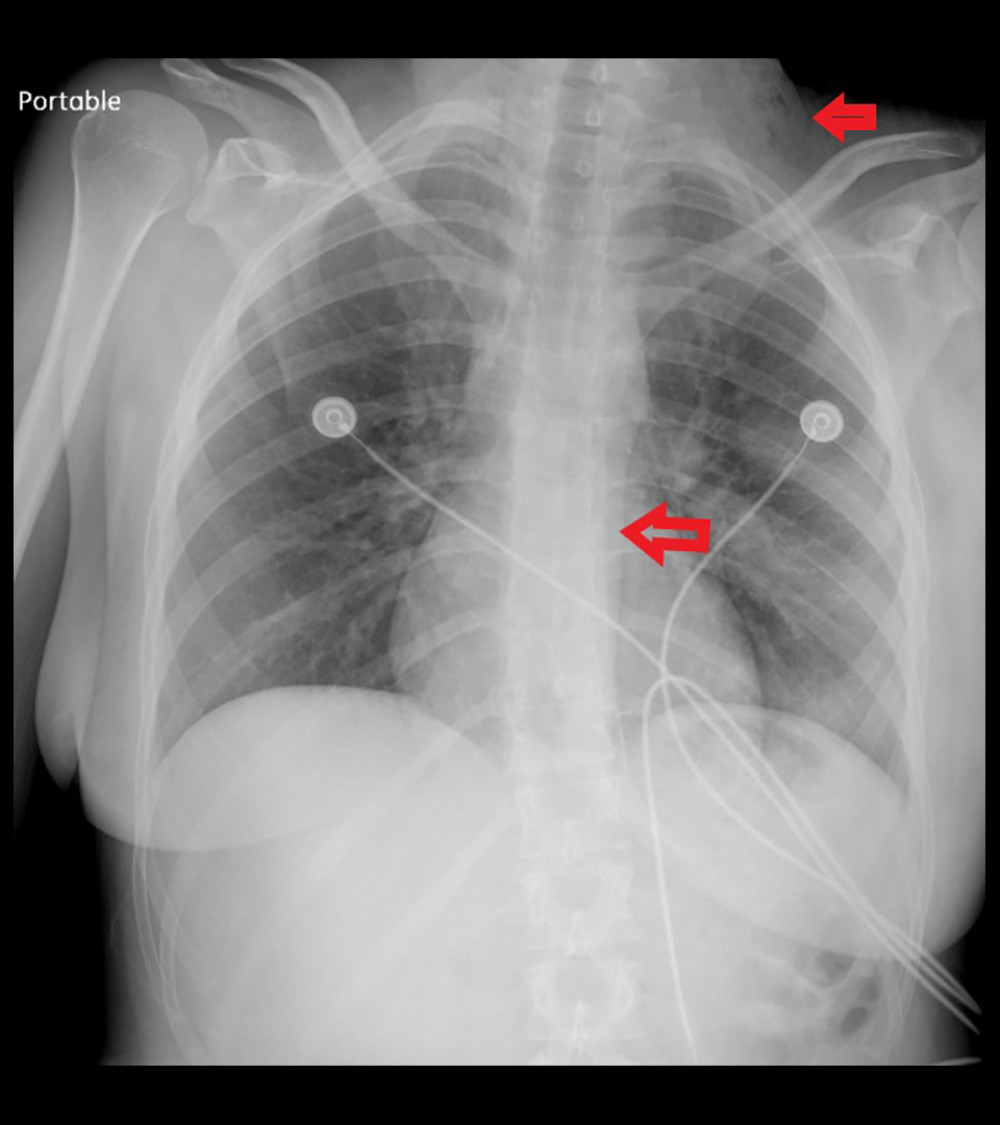 A plain chest radiograph showing a frank pneumomediastinum with gas accumulation outlining the thoracic aorta as well as extension into the superior mediastinal region and lower cervical region, bilaterally left greater than right (lower red arrow), and subcutaneous emphysema on left side (upper red arrow).