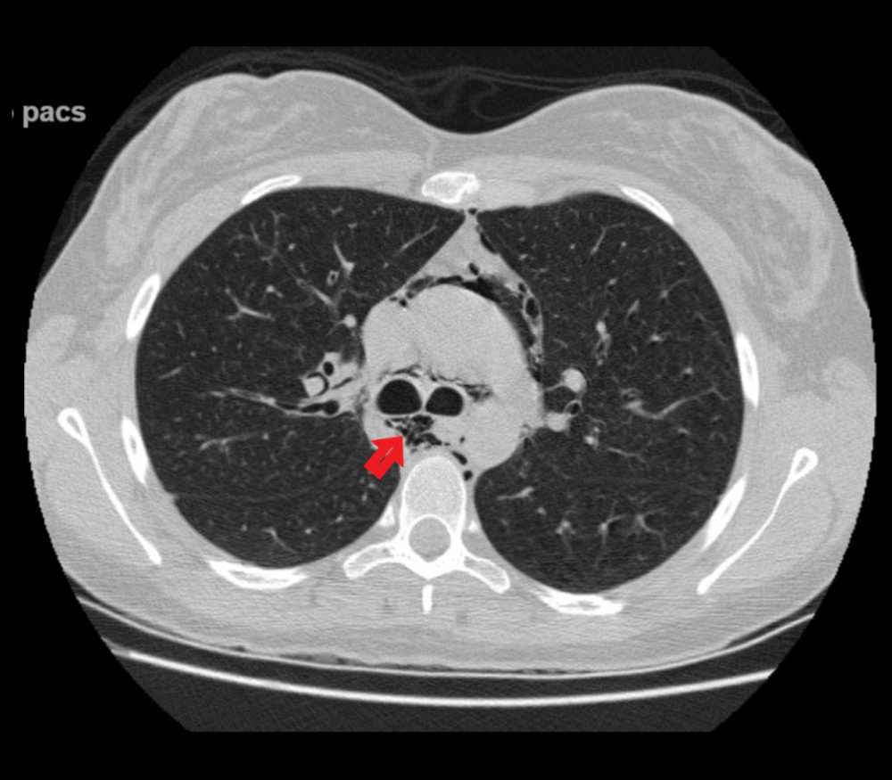 Axial computed tomography of the chest showing extensive pneumomediastinum surrounding the right and left main bronchi (red arrow), and around the ascending aorta and pulmonary trunk.