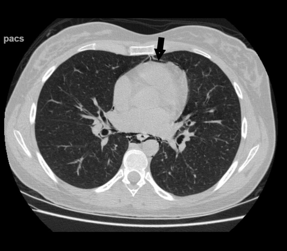 Axial computed tomography of the chest showing pneumopericardium (the presence of air within the pericardium; black arrow).