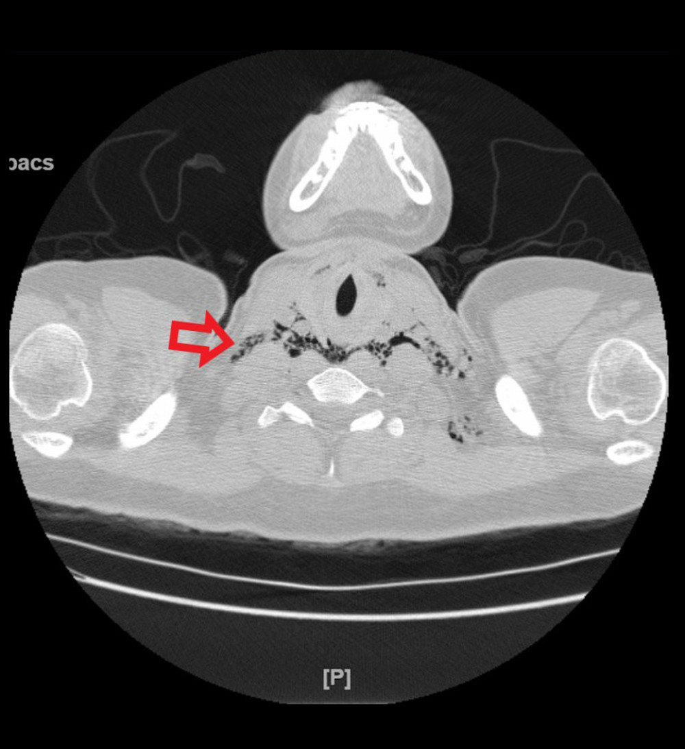 Axial computed tomography of the neck showing subcutaneous emphysema and retropharyngeal emphysema (red arrow).