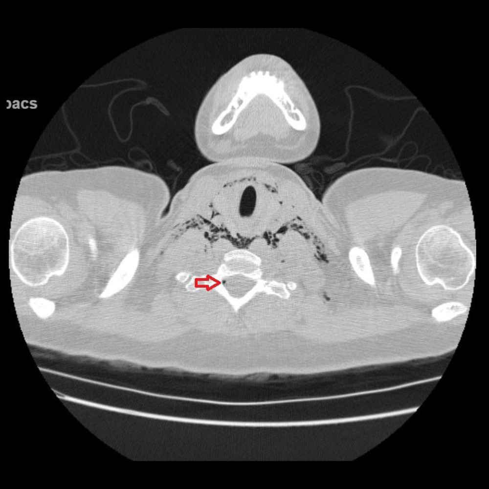 Axial computed tomography of the neck showing the presence of air within the spinal canal (red arrow).