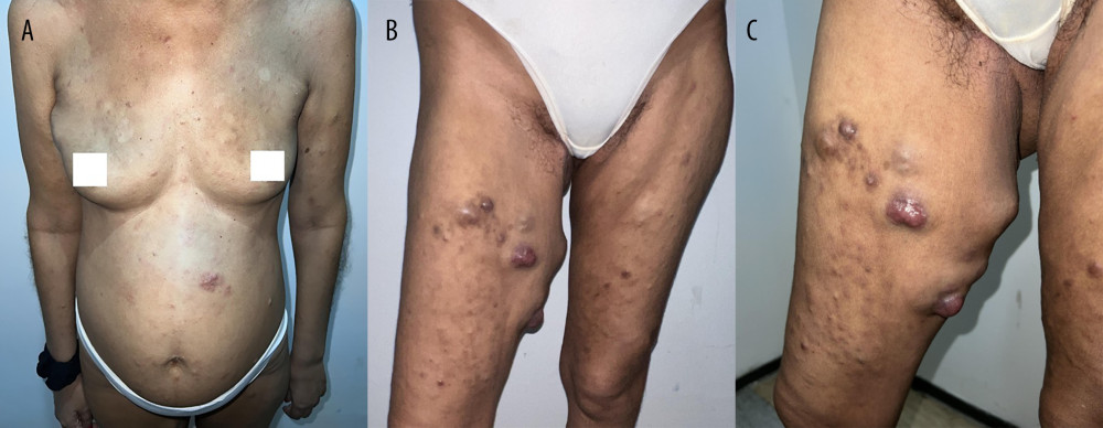 (A–C) Patient’s initial presentation. Diffusely distributed nodular and infiltrative lesions of variable dimensions were observed on physical examination. There were also hard, painless, subcutaneous masses in the right infra-axillary region.