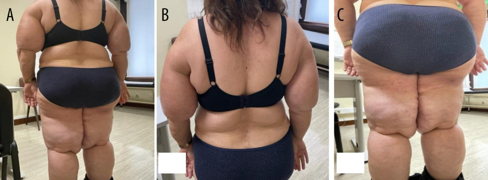 A 49-year-old woman identified as obese and diagnosed with Launois-Bensaude syndrome. No frontal pictures were allowed by the patient. (A) Multiple symmetrical subcutaneous masses of adipose tissue are shown to affect the whole body, predominantly the upper and lower limbs; (B) Multiple symmetrical subcutaneous masses of adipose tissue involve the upper limbs and neck; (C) Multiple symmetrical subcutaneous masses of adipose tissue involve the buttocks and lower limbs.