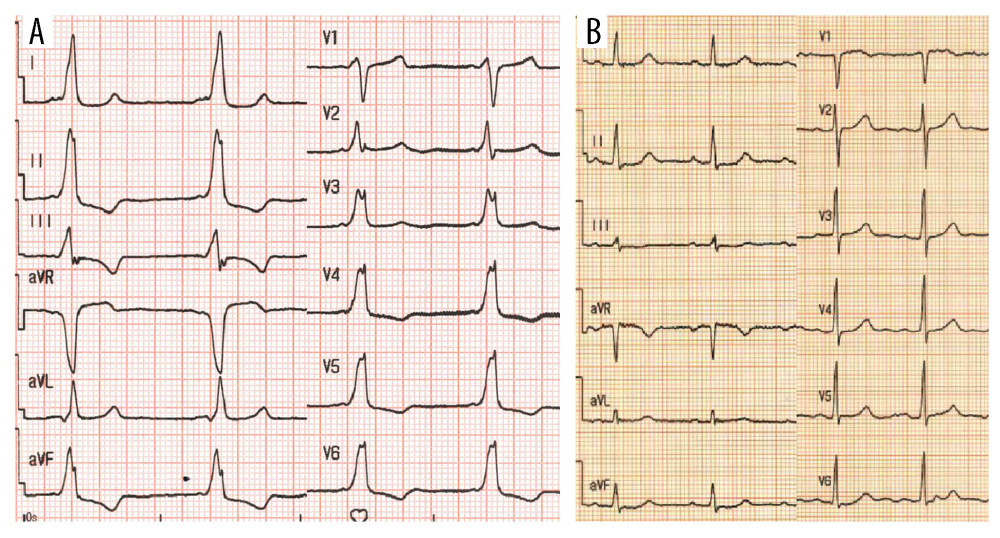 Comparison of electrocardiogram at presentation and 1-month follow-up. (A) Initial electrocardiogram showed short PR interval, prolonged QRS duration (163 ms), and initial upstroke (delta wave). (B) Electrocardiogram after catheter ablation at 1-month follow-up demonstrated QRS duration narrowed and delta wave disappeared.