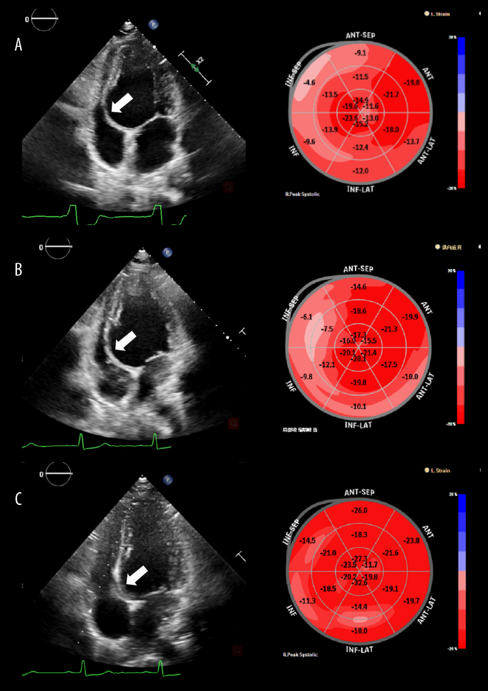 Comparison of echocardiogram. (A) Preoperative echocardiogram showed left ventricle dilation, basal segment of ventricular septum thinning, and regional wall swung toward the right ventricle in the systolic period (marked by arrow). Left ventricular longitudinal strain images displayed dyssynchronous left ventricle motion (left ventricle global longitudinal strain [LVGLS], 14.7%). Septal segments of the left ventricle had most abnormal strain values. (B) There was a recovery trend of paradoxical movement in ventricular septum after catheter ablation (marked by arrow). Left ventricular systolic function improved slightly (LVGLS, 15.8%). (C) The structure and synchrony of ventricular septum improved significantly 6 months after catheter ablation (marked by arrow; LVGLS, 19.7%).