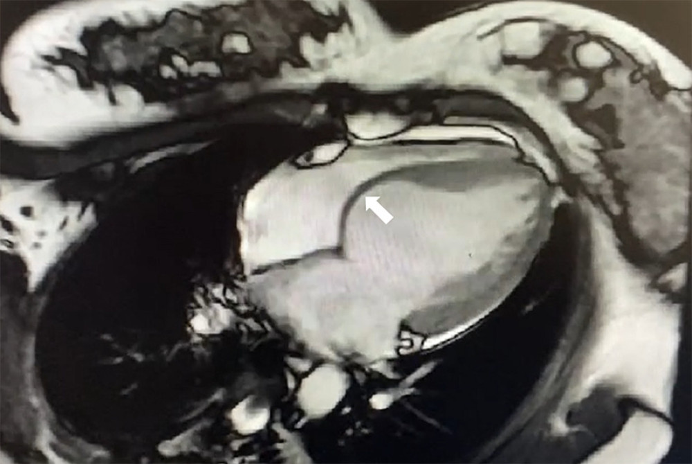 Cardiac magnetic resonance imaging. The basal ventricular septum was significantly thinning (3–4 mm) with paradoxical motion. The regional wall swung toward the right ventricle in the systolic period like an aneurysm. No obvious myocardial fibrosis was observed.