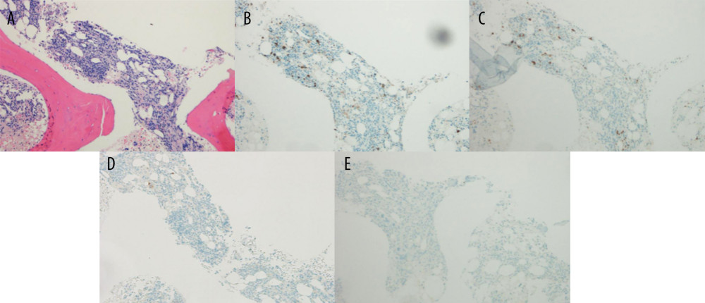 Bone marrow biopsy revealed a hypercellular marrow with trilineage hematopoiesis. (A) Hematoxylin and eosin staining (magnification ×10). Immunohistochemistry studies show (B) decreased erythrocytosis by CD71 (×10) that are primarily erythrocyte precursors by (C) E-cadherin (×10), indicating minimal maturing erythroid lineage present beyond erythrocyte precursors. No evidence of melanoma by (D) Melan-A (×10), and (E) SOX10 (×10).