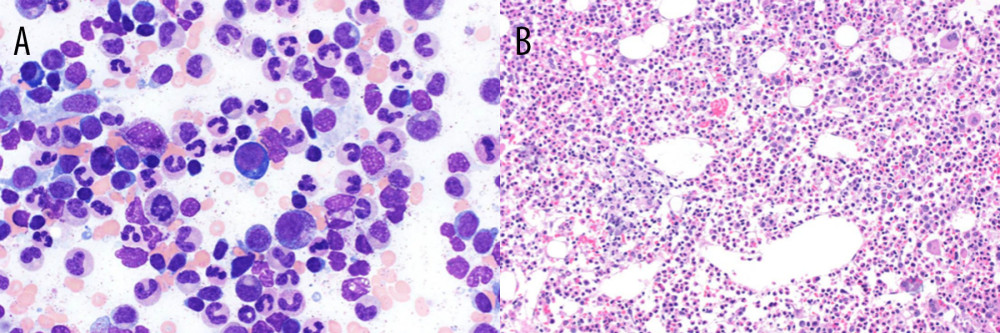 (A) Bone marrow aspirate and (B) core biopsy show hypercellular bone marrow with markedly decreased and left shifted erythropoiesis. Only rare scattered pronormoblasts were identified on the aspirate, and the biopsy showed inconspicuous erythroid islands with virtually no maturation. There was background megakaryocytic and granulocytic hyperplasia. (A) Wright Giemsa, 600× oil. (B) Hematoxylin and eosin, 200×.