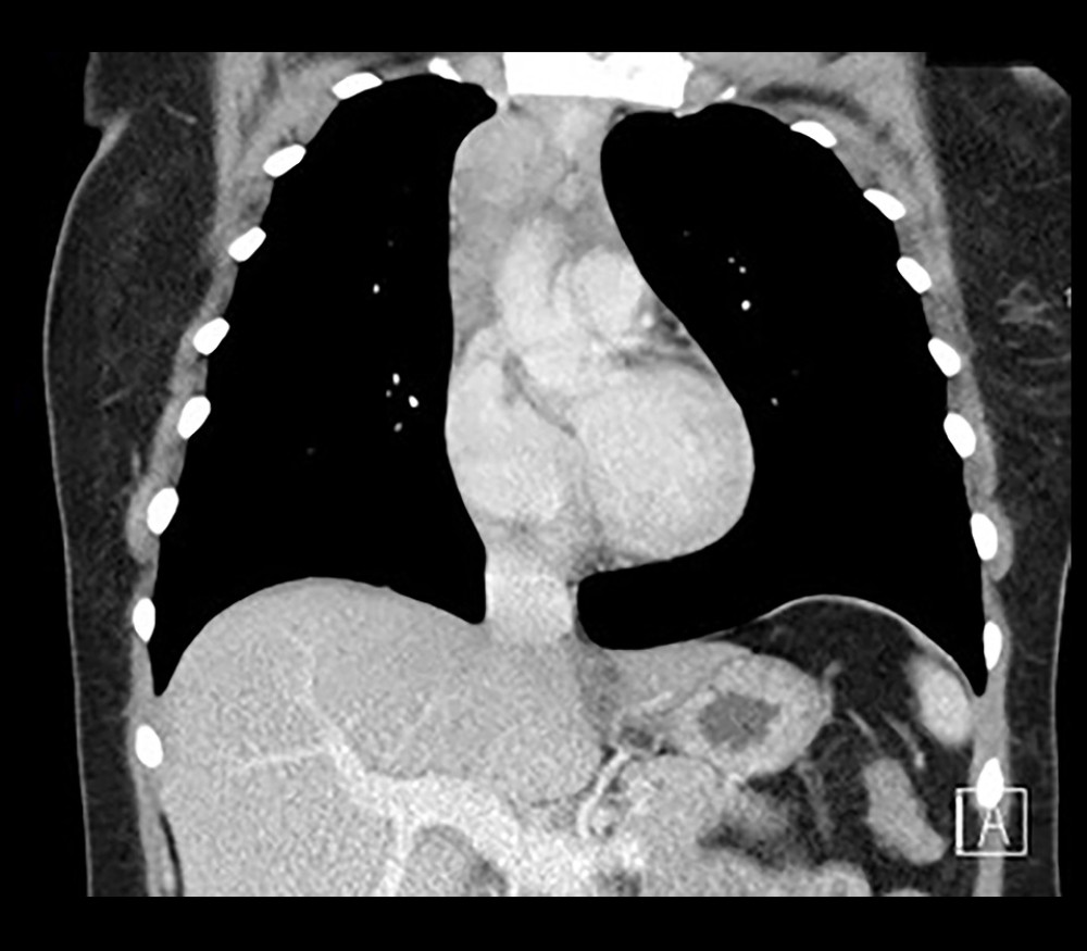 Contrast-enhanced chest computed tomography shows homogeneous anterior mediastinal soft tissue mass, with no vascular involvement.