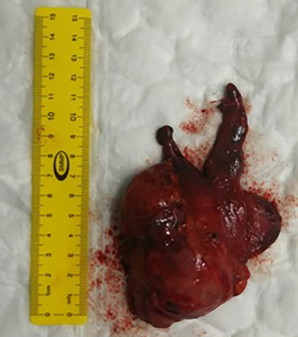 Grossly brown and lobulated thymus that weighed 93 g and measured 9×8×3.5 cm.