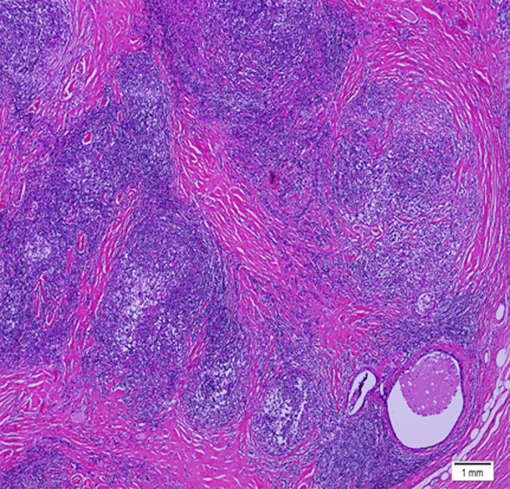 Scanning magnification shows variable sized nodules surrounded by fibrous collagen bands with adjacent thymic epithelial cyst (immunohistochemistry, original magnification 100×).