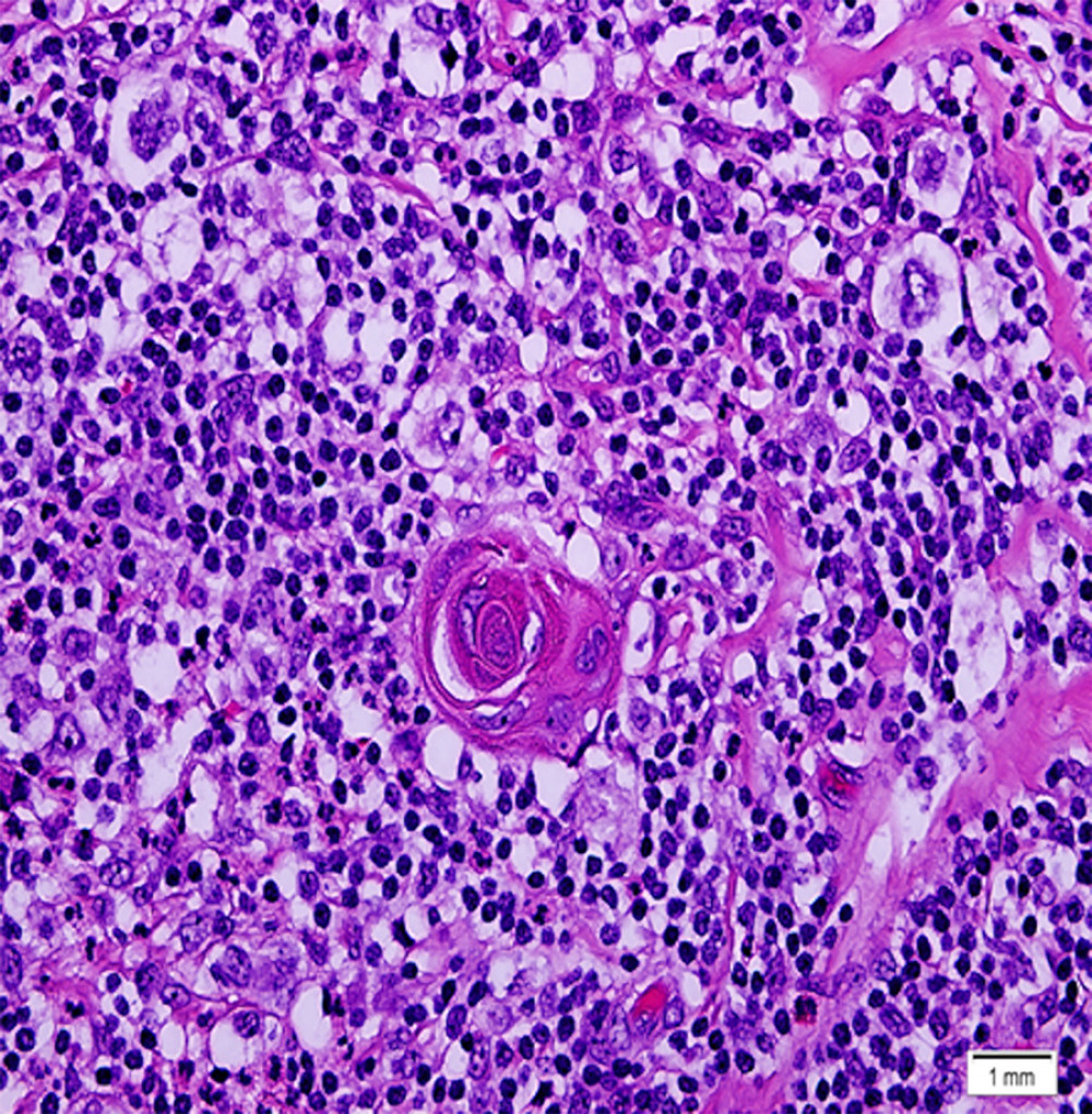 Hassall corpuscle surrounded by Hodgkin cells (immunohistochemistry, original magnification 100×).