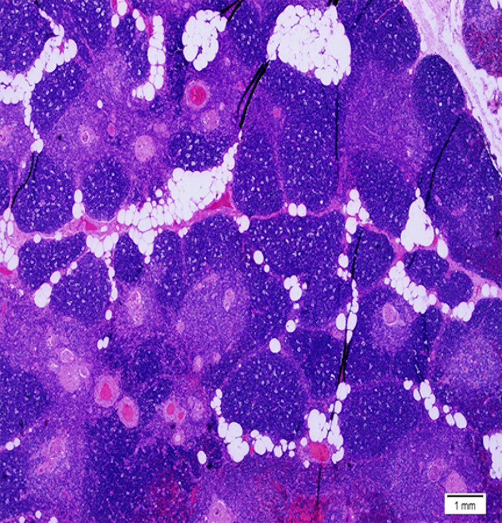 Thymic epithelial hyperplasia (immunohistochemistry, original magnification 100×).