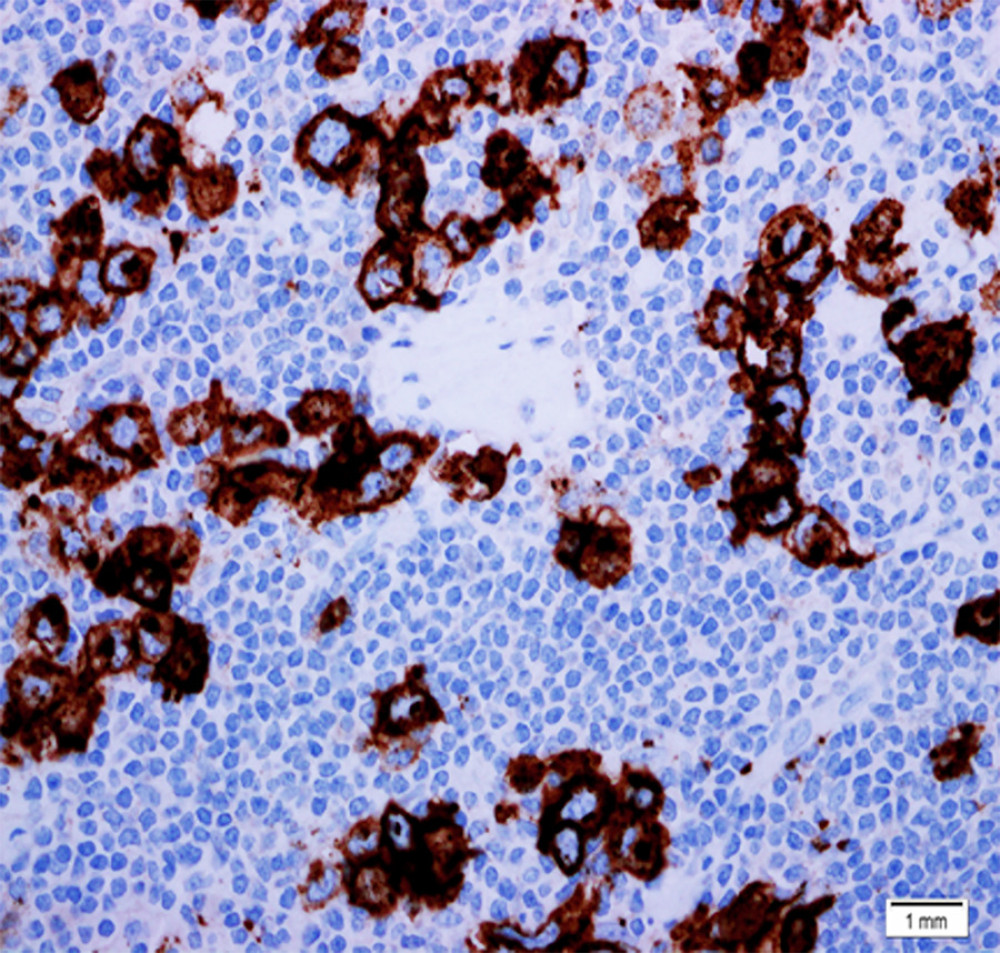 Membranous and perinuclear staining pattern for CD15 in thymic Hodgkin and Reed-Sternberg cells (immunohistochemistry, original magnification 200×).