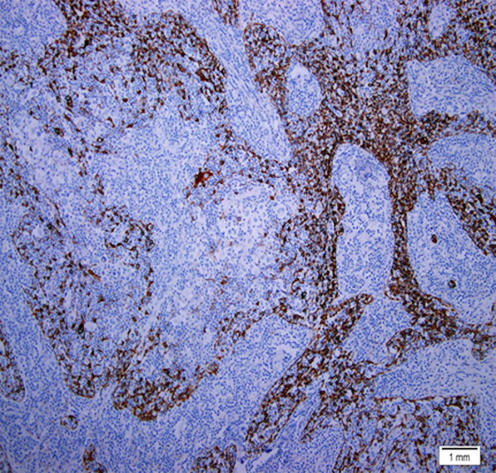 Membranous staining on an arborizing pattern for cytokeratin 19 with prominent in between negative lacunar cells (immunohistochemistry, original magnification 100×).