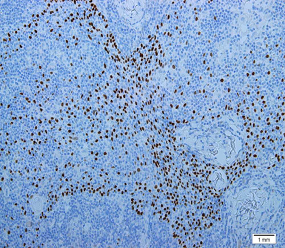 Nuclear positivity for protein 63 (immunohistochemistry, original magnification 100×).
