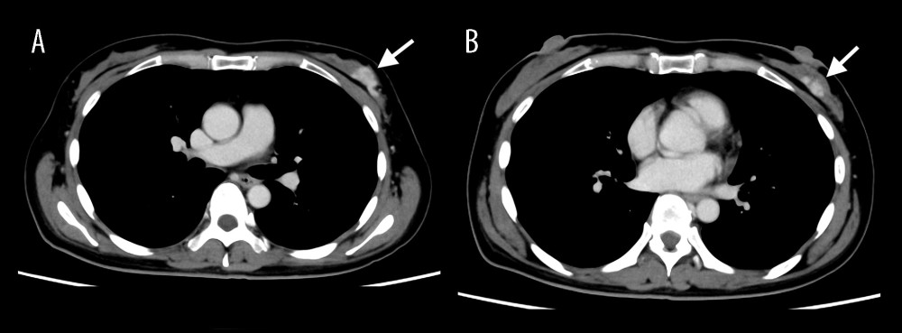 Whole-body contrast-enhanced computed tomography on day 4 of admission. (A, B) Note the absence of abnormal findings except for multiple enhanced nodules in the superior external quadrant in the left breast (white arrows), which were suspicious for incidental breast cancer.