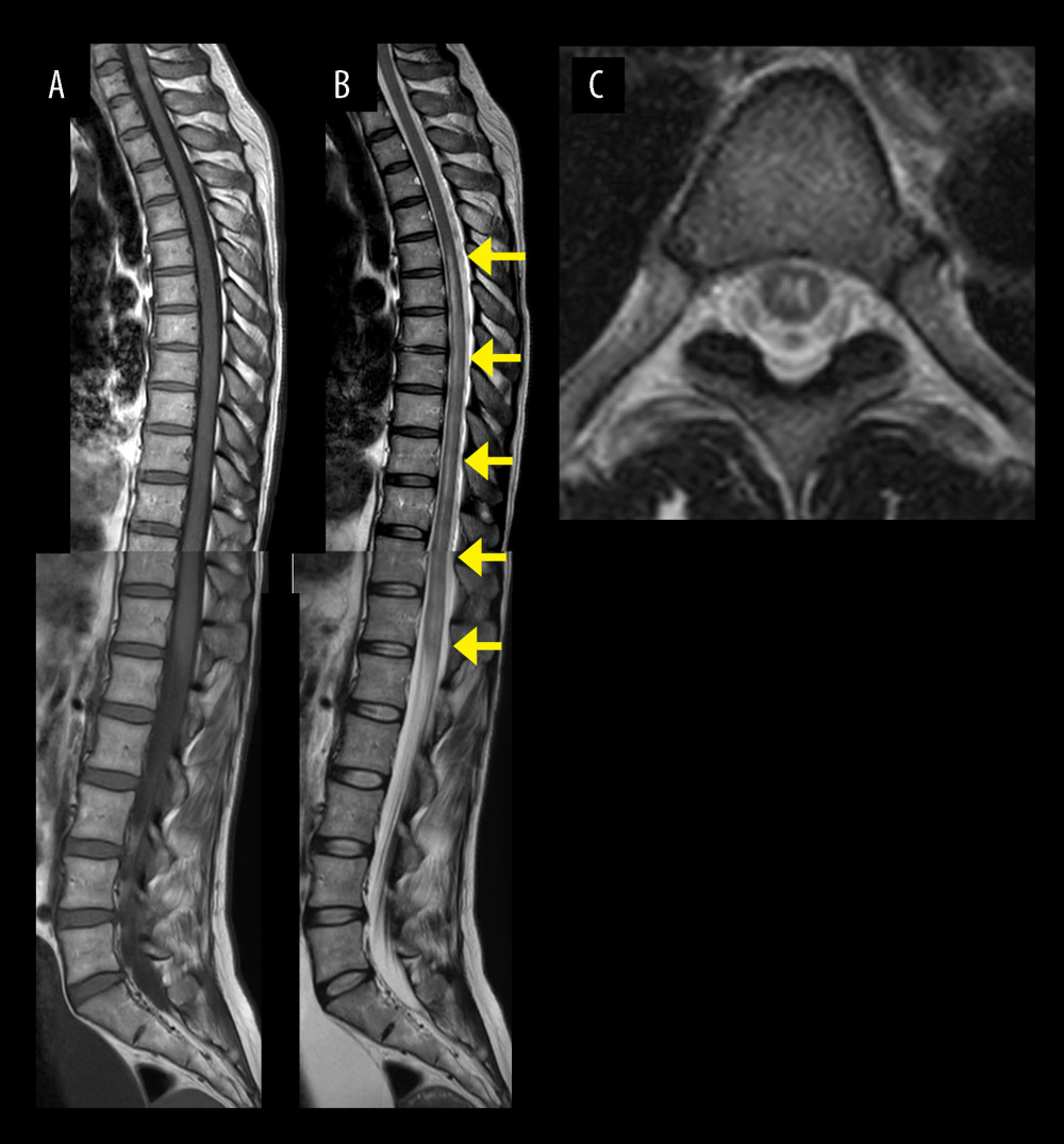 Magnetic resonance imaging (MRI) of the thoracic and lumbar spinal cord on day 29 of admission. (A) Sagittal T1-weighted image shows slightly swollen lower thoracic and lumbar spinal cord. (B) Sagittal T2-weighted image shows longitudinal abnormal lesions extending from Th5 to the medullary cone (yellow allows), consistent with longitudinal extensive transverse myelitis. (C) Axial T2-weighted image at the level of Th5 shows that these lesions mainly occupy the gray matter of the spinal cord.