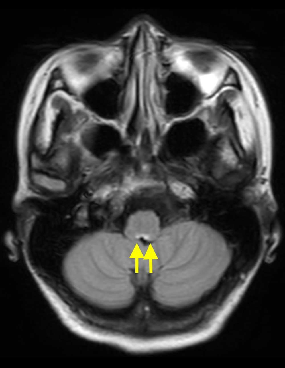 Brain magnetic resonance imaging on day 8 of admission. Retrospective evaluation reveals a small linear hyperintense lesion (yellow arrows) in the dorsal medulla oblongata on fluid-attenuated inversion recovery sequence image (FLAIR).