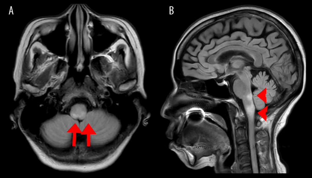 Brain magnetic resonance imaging on day 39 of admission. (A) Axial fluid-attenuated inversion recovery sequence (FLAIR) image shows hyperintense signals with blurred borders in dorsal medulla oblongata (red arrows). (B) Sagittal FLAIR image shows lesions spreading to caudal medulla oblongata (red arrowheads).