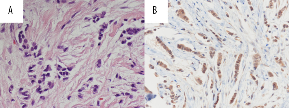 Histopathological features of breast tumor specimens obtained with core needle biopsy. (A) Tumor cells invade the fibrous stroma, suggesting scirrhous-type invasive ductal carcinoma (hematoxylin/eosin staining, ×400). (B) Immunohistochemical staining demonstrates abundant aquaporin-4 expression in tumor cells with negative immunoreactivity observed in the normal breast parenchyma (Anti-AQP4; Atlas Antibodies, Stockholm, Sweden; ×400).