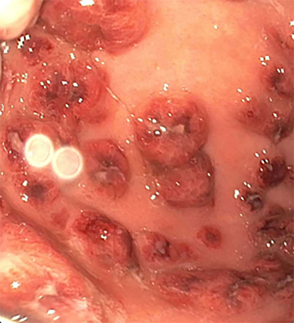 Endoscopic picture of the gastric body showing several hemorrhagic, annular lesions.