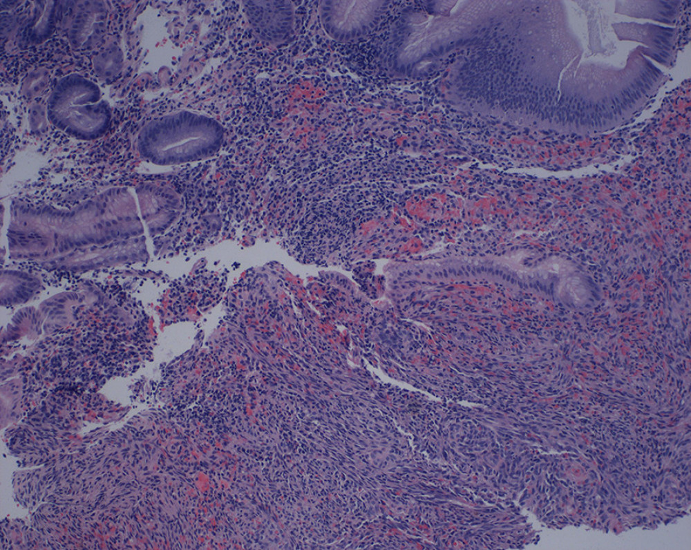Gastric body biopsy shows atypical spindle cells with mild to moderate nuclear atypia, extravasated red blood cells and rare mitoses (hematoxylin and eosin, original magnification ×100).
