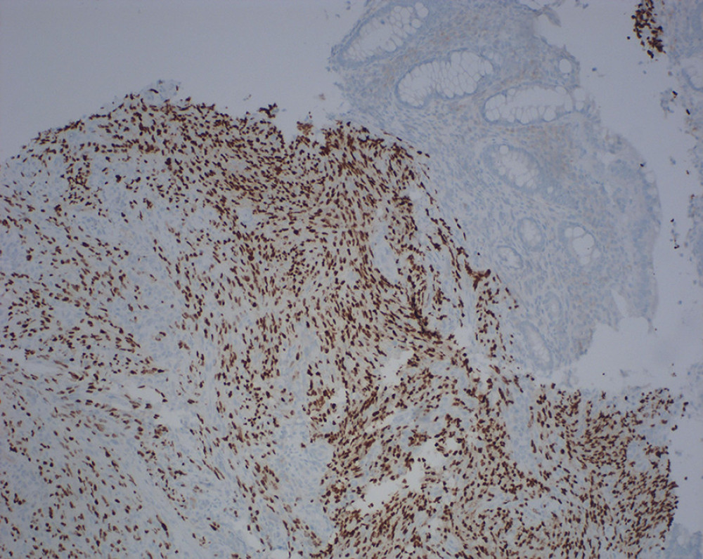 HHV-8 immunohistochemical stain shows nuclear positivity in atypical spindle cells, supporting the diagnosis of Kaposi sarcoma.