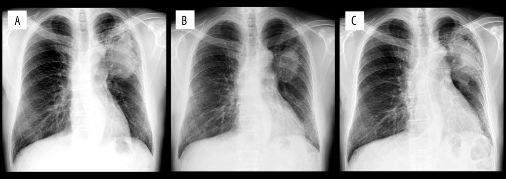 (A) Chest radiograph obtained at the first visit to our department revealed a mass extending into the left upper and middle lung field. (B) Upon administration of tegafur/gimeracil/oteracil (S-1) as fourth-line chemotherapy, the mass appeared reduced in size on the chest radiograph, compared with its appearance before chemotherapy. (C) At the time of the appearance of purpura, the tumor was once again enlarged despite treatment with 7 courses of S-1.