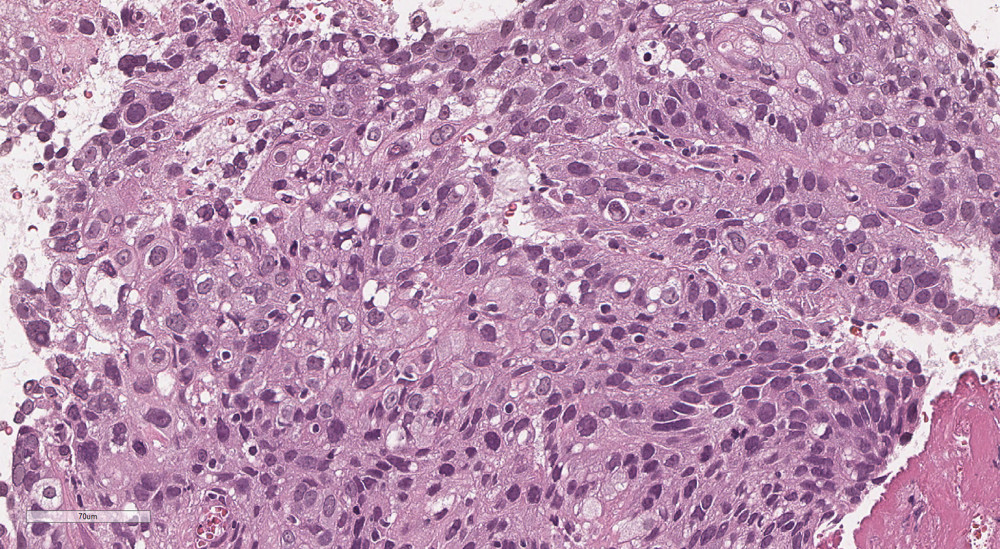Hematoxylin-eosin staining of a transbronchial lung biopsy specimen from the left upper lobe mass revealing clusters of large atypical cells and areas of stratified growth, indicating a squamous cell carcinoma. Immunostaining was positive for p40 and cytokeratin 5/6 and negative for thyroid transcription factor-1 and napsin A. The final histological type could not be determined, and the pathological diagnosis was non-small cell carcinoma (×300).