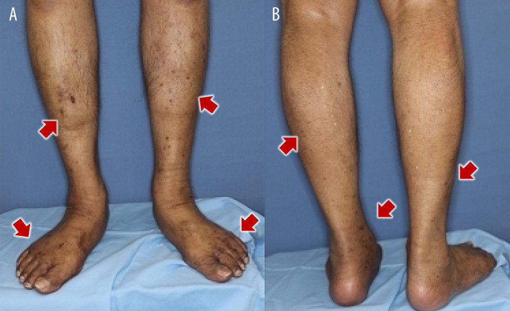 (A, B) Photographs of the bilateral lower extremities at the time of presentation for purpura. Palpable purpura and edema in multiple locations were present in the lower extremities.