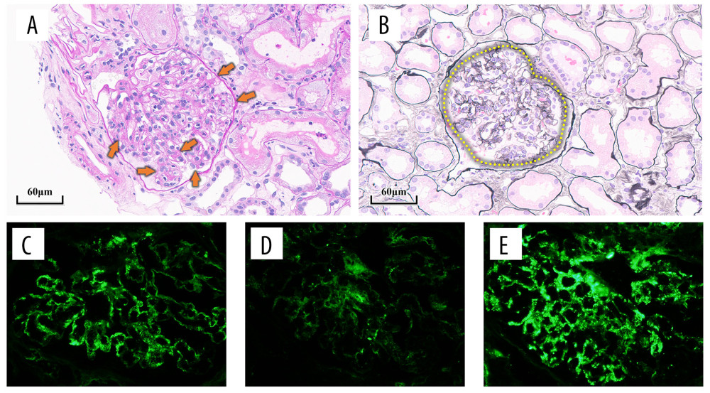 Kidney biopsy specimens demonstrated numerous proliferations of the mesangial areas and endocapillary proliferation, stained with (A) periodic acid-Schiff (×300) and (B) periodic acid-methenamine silver. Immunofluorescent studies revealed deposition of (C) immunoglobulin A and (E) C3, without (D) immunoglobulin M, in superficial blood vessels (×400).